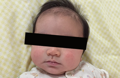 生後3か月。ほっぺの赤みがこの日は少しマシ。。いくつかの肌トラブルを経て、0歳7か月でアレルギー発覚する。（アレルギーブログの記録より）